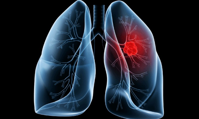 O que é o Check-UP Cardiopulmonar?