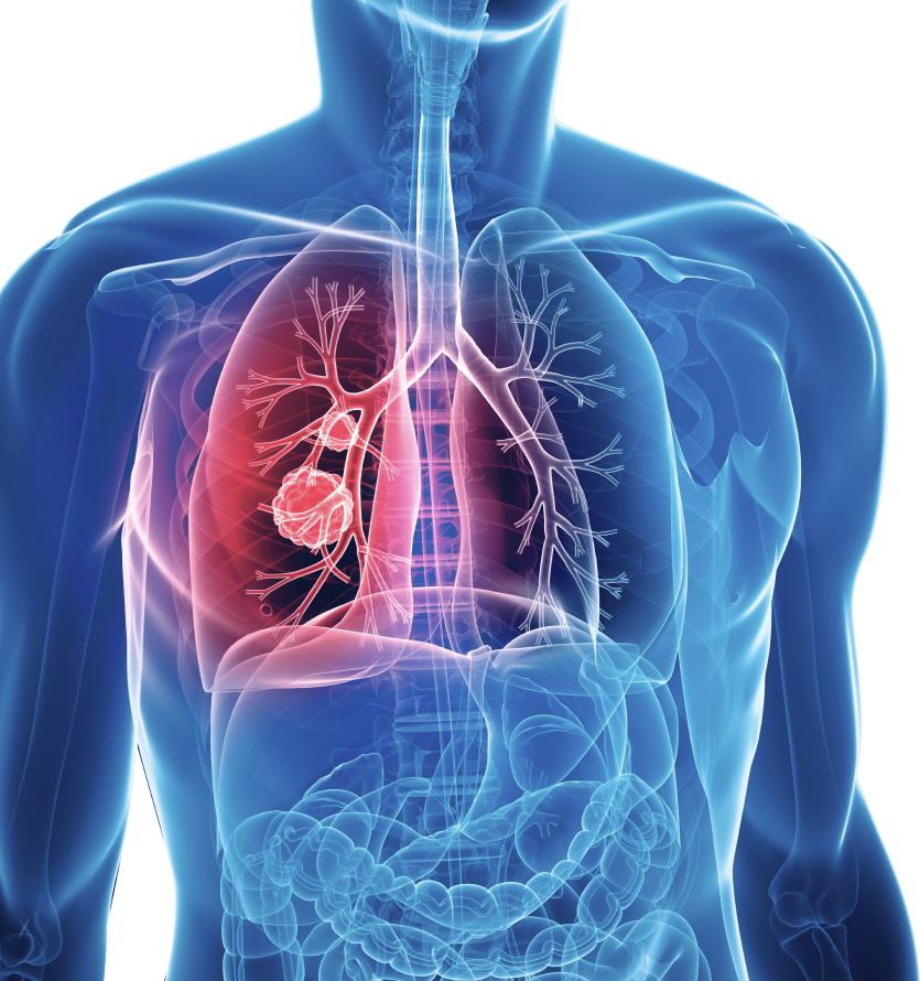 Neoplasias Pulmonares