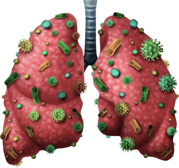 Pneumonia